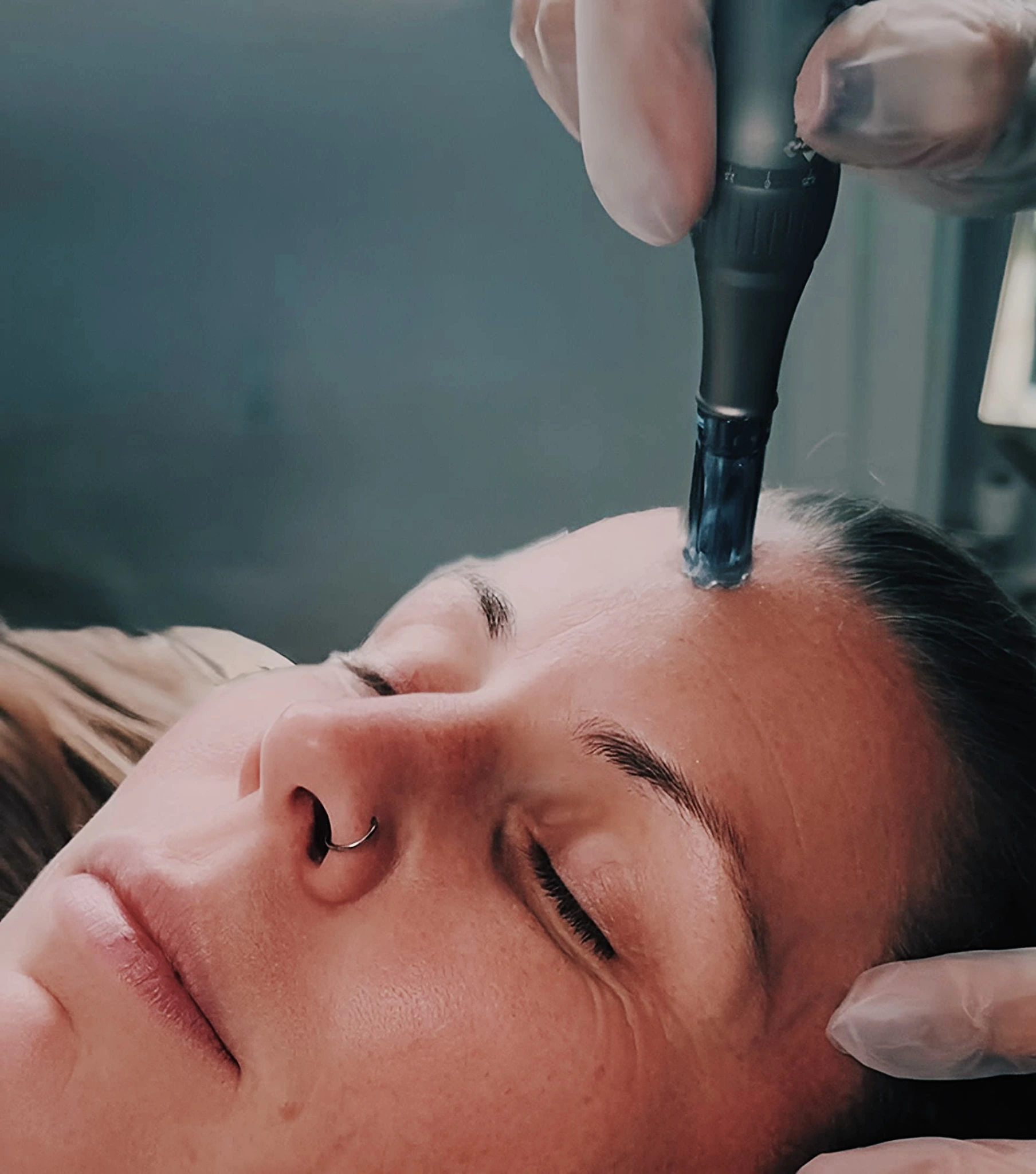 Microneedling